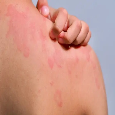 rash_in_children